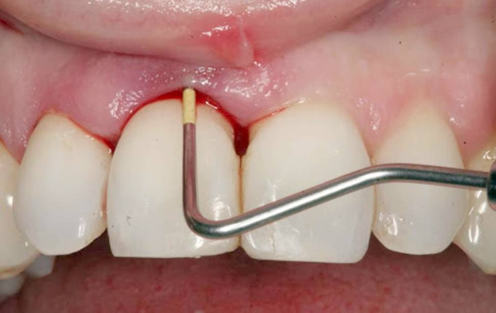 جرم دندان چیست و جرم گیری چه کاری انجام می دهد؟